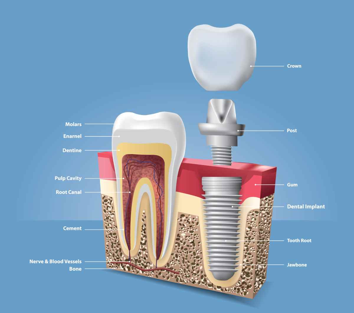 A detailed graph of all the different parts of a dental implant and surronding anatomy