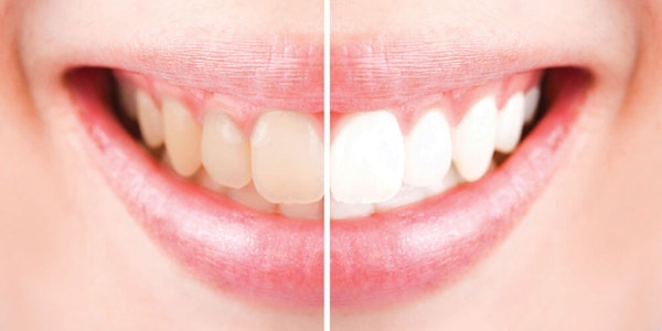 Teeth Whitening Hamilton